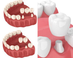 Bridges vs. dental crowns