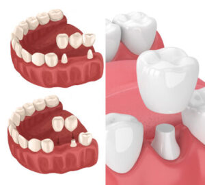 Bridges vs. dental crowns