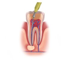 Illustration of a tooth receiving root canal therapy