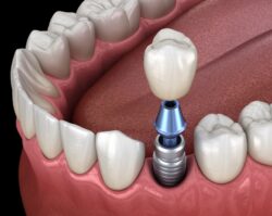 dental implants and dentures, tooth replacement options, Blue Valley Smiles, Overland Park dentist, Dr. Rachel Karabas, Dr. Todd O'Neil, Dr. Michelle Bhaskar, dental care, oral health, implant-supported dentures