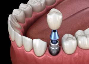 dental implants and dentures, tooth replacement options, Blue Valley Smiles, Overland Park dentist, Dr. Rachel Karabas, Dr. Todd O'Neil, Dr. Michelle Bhaskar, dental care, oral health, implant-supported dentures