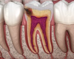 stages of tooth decay, prevent tooth decay, Blue Valley Smiles, Overland Park KS dentist, dental health tips, Dr. Rachel Karabas, Dr. Todd O'Neil, Dr. Michelle Bhaskar, tooth decay treatment