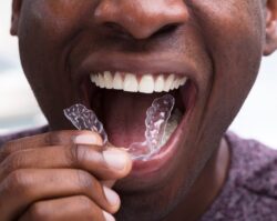 SureSmile clear aligners