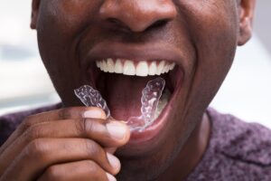 SureSmile clear aligners