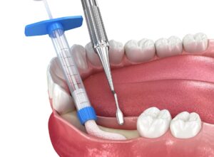 prevent bone loss after tooth extraction with bone grafting or dental implants