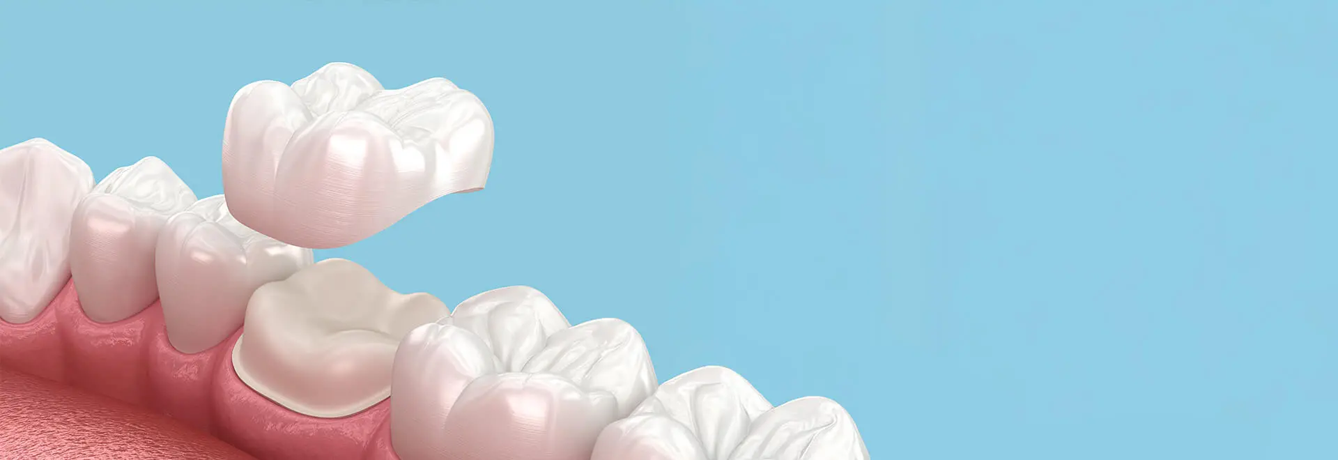 Dental Crowns & Bridges | Blue Valley Smiles