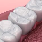 image of dental filling on molar tooth
