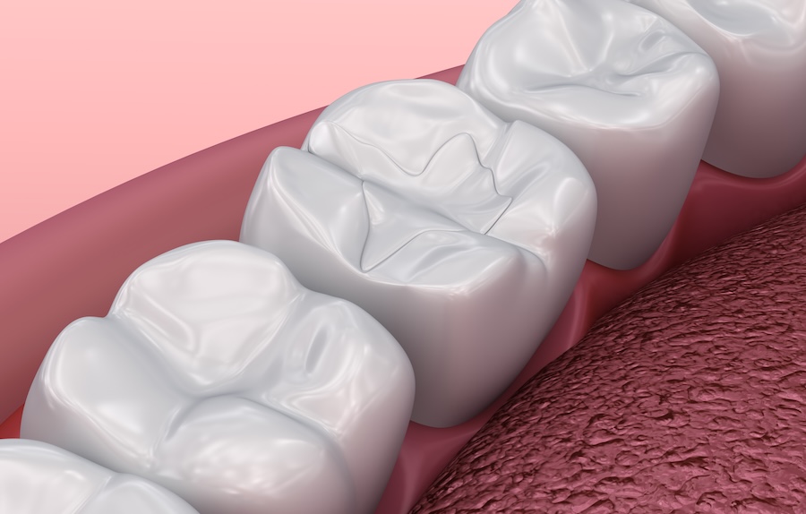 image of dental filling on molar tooth