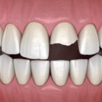 broken front tooth from dental trauma
