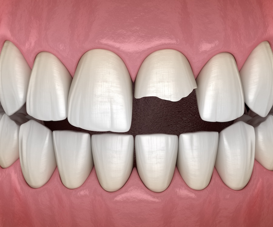 broken front tooth from dental trauma