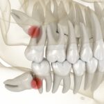 wisdom teeth impaction