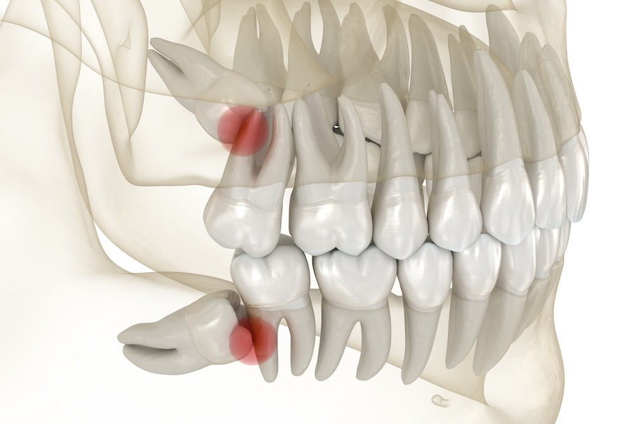 wisdom teeth impaction