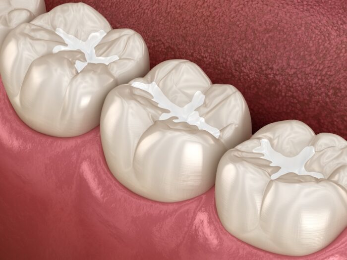 dental sealants on a molar tooth to prevent dental filling