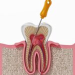 root canal therapy